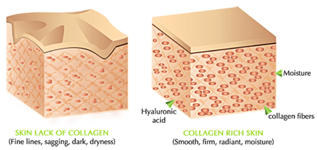 collagen rich skin with hyaluronic acid fillers versus lack of collagen skin epidermis infographic