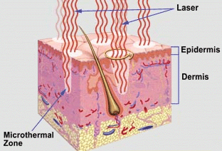 illustration of how fractional co2 laser penetrates skin layer