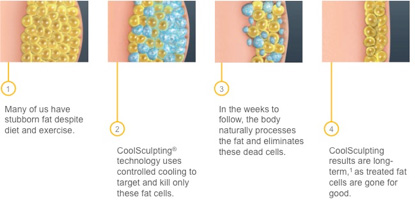 illustration of how coolsculpting works