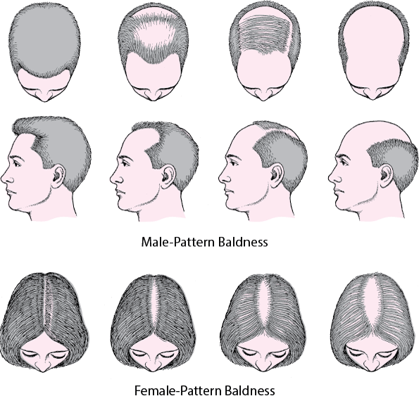 infographic of male and female pattern hair loss or Alopecia