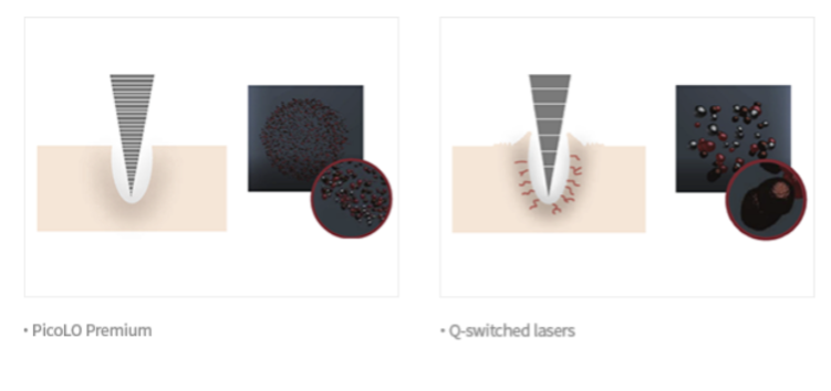 difference of how picolo premium and q-switched lasers work on skin dermis