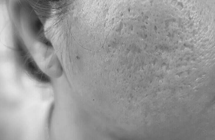 close up of acne scars on a woman face monotone