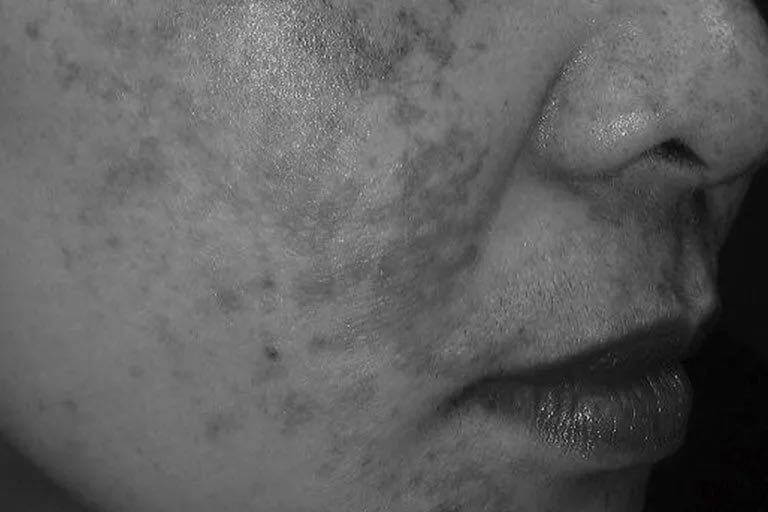 close up of pigmentation on a woman face monotone