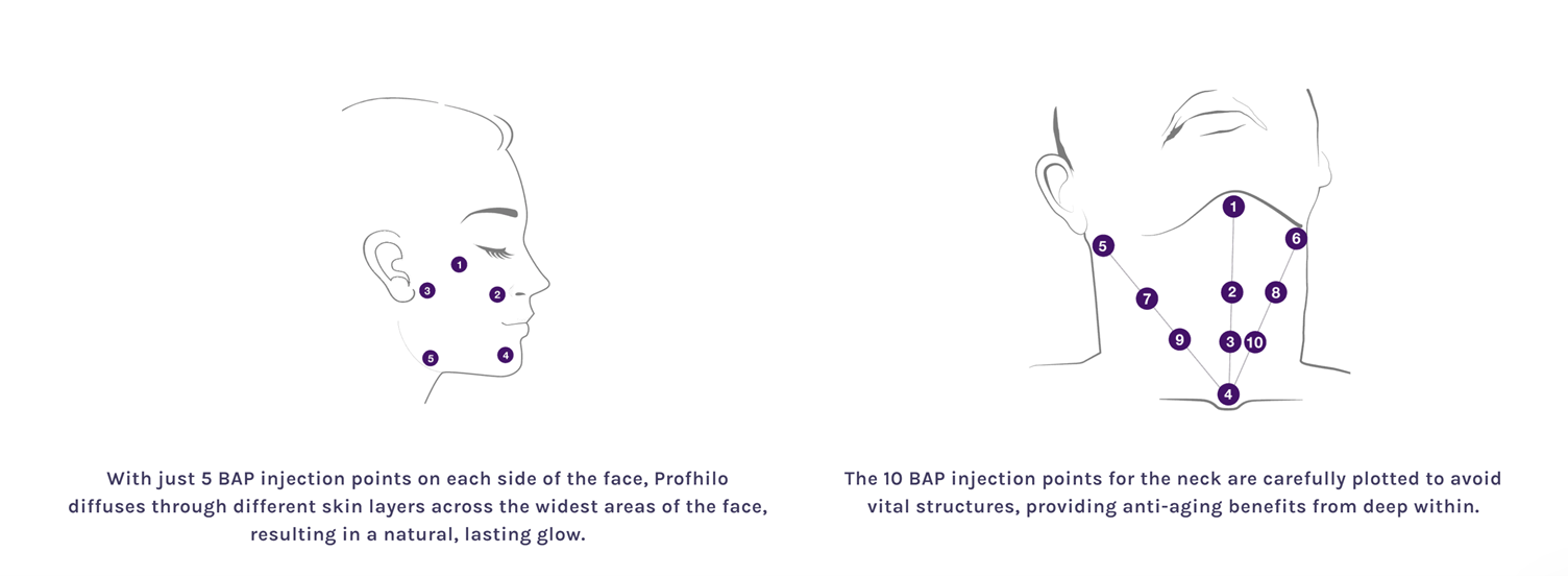 Profhilo filler (逆时针) Singapore - J Laser and Aesthetics Clinic