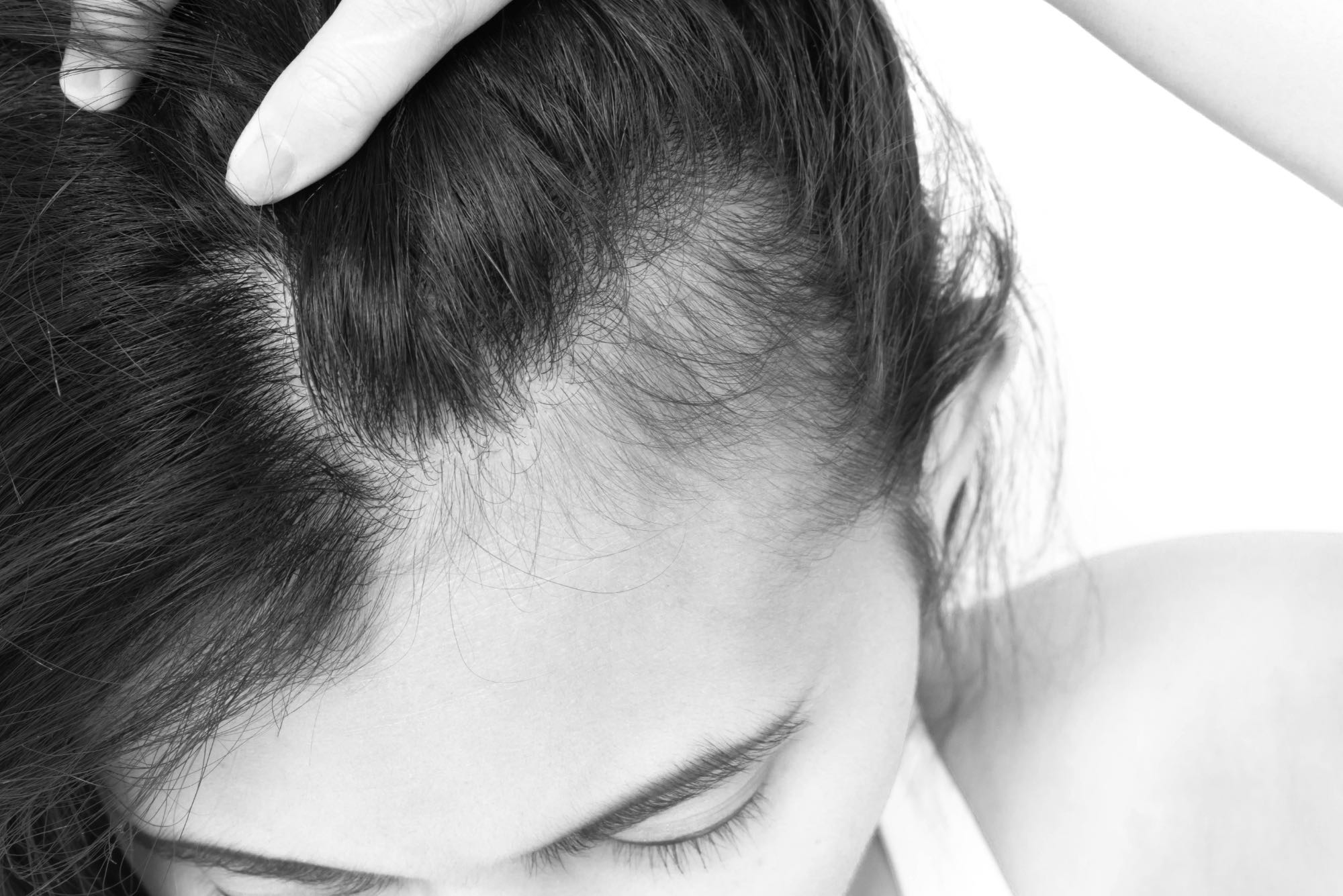 woman at aesthetic clinic lifting hair to show hair loss near side monotone