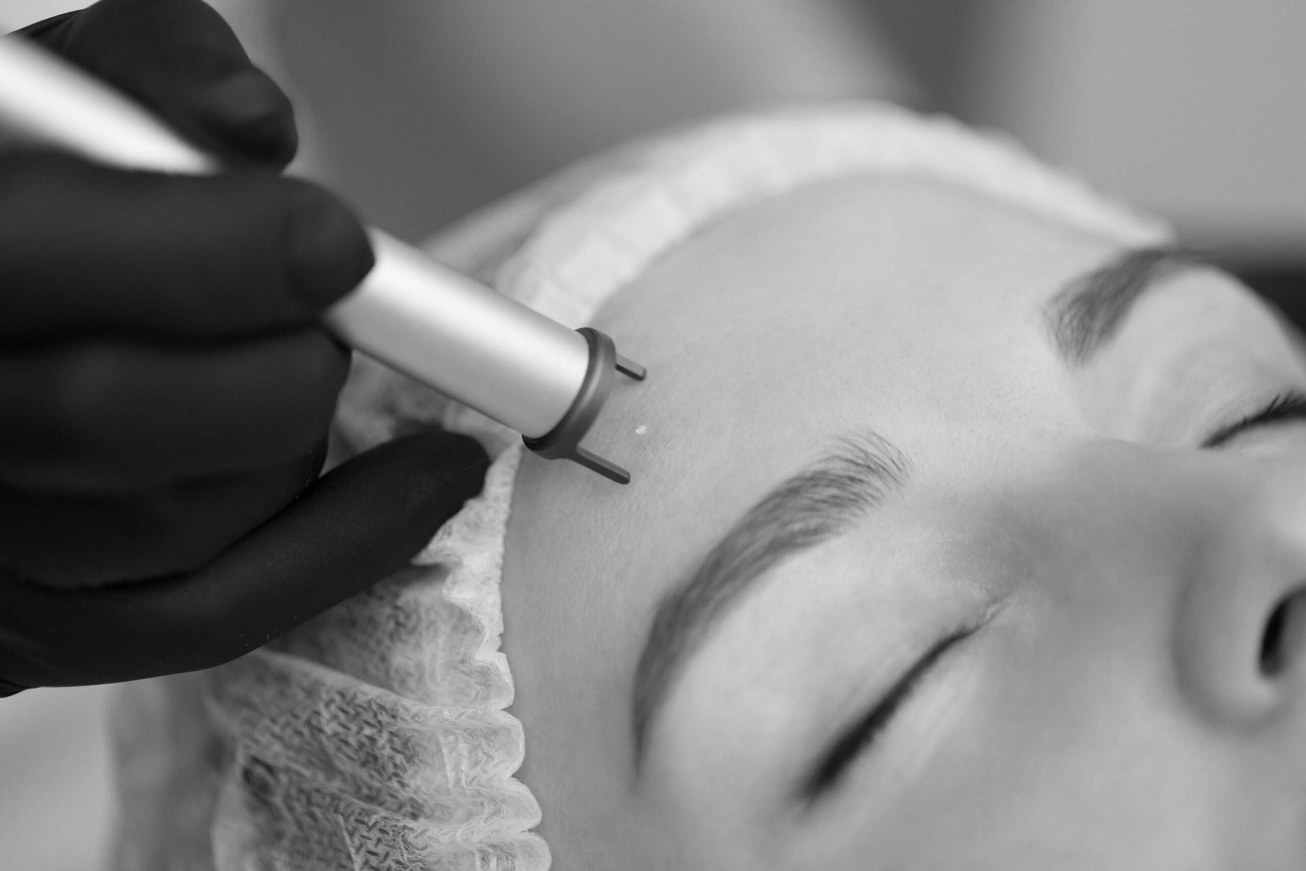 close up of a woman doing pigment laser treatment black and white color