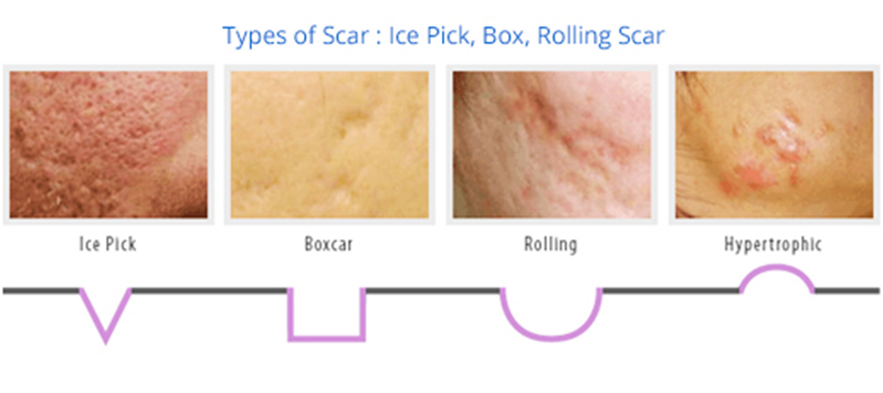 infographic of types of acne scar