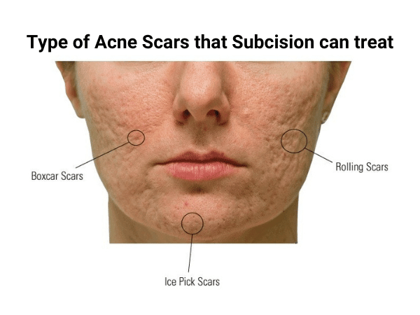 subcision with dermal fillers for acne scars-min